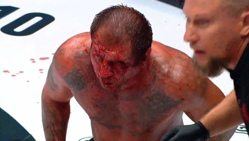 ФОТО. Ужасное лицо после боя. Емельяненко попал в больницу с переломом носа