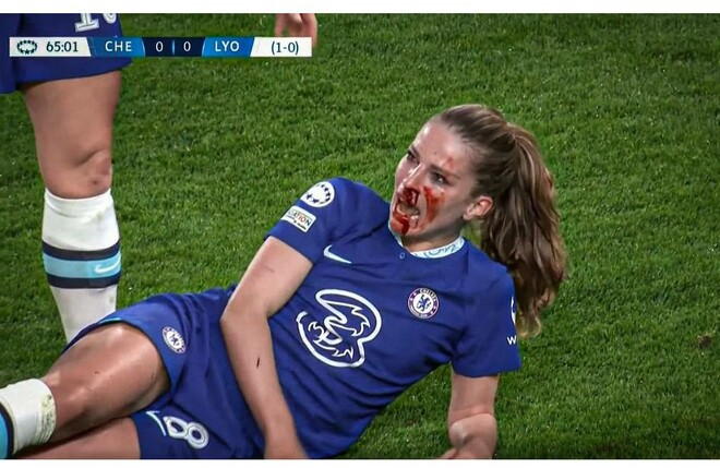 ВИДЕО. Разбили лицо в кровь. Ужас в игре между Челси и Лионом в женской ЛЧ