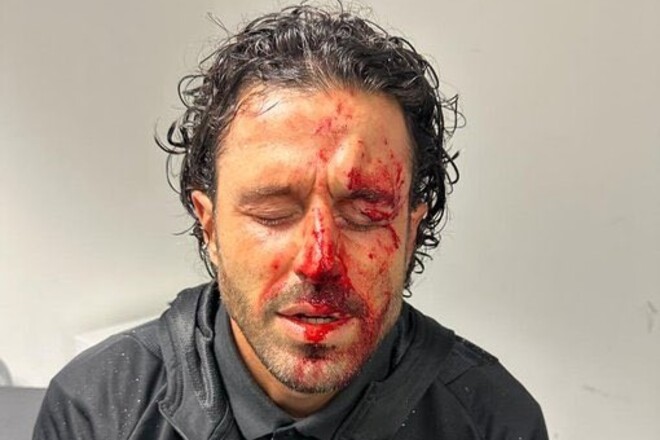 Гроссо наложили 13 швов на лицо после атаки фанатов Марселя