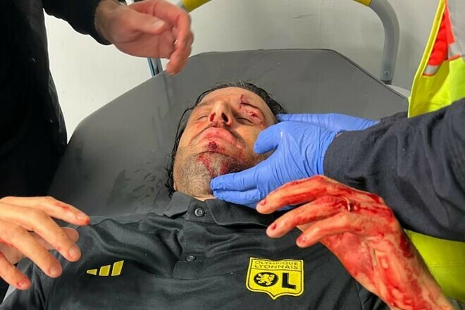 ФОТО. Який вигляд має тренер Ліона після атаки фанатів Марселя та операції
