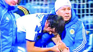 Милевскому собирали кость по осколкам